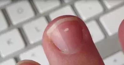宝宝指甲月牙少有白点怎么回事,宝宝指甲出现空甲现象怎么办