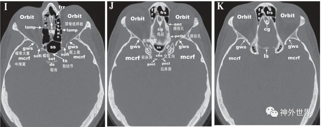 颅底骨折合并脑脊液漏伤情鉴定,颅底骨折伴脑脊液漏右眼眶骨折