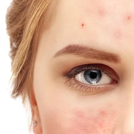 辟谣、吃酱油加深痘印？芦荟胶治好痘坑？别傻了！