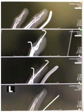在日本骨折的人,日本骨折