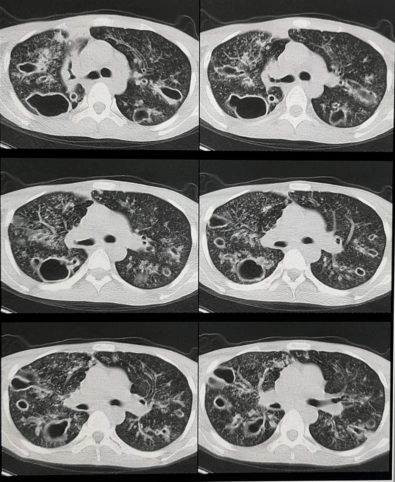 小伙在网吧呆了十年肺结核,父母离异的网吧小伙