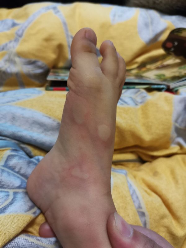 宝宝身上起疙瘩像蚊子咬一样还痒,宝宝身上长疙瘩像蚊虫叮咬怎么办