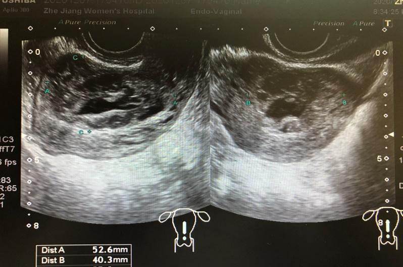 产后出血副胎盘残留病例分析,病例分析产科