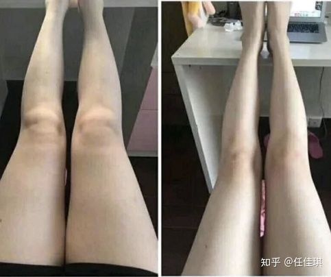 脂肪腿、肌肉腿、水肿腿的救星！这样的瘦腿训练效果最好