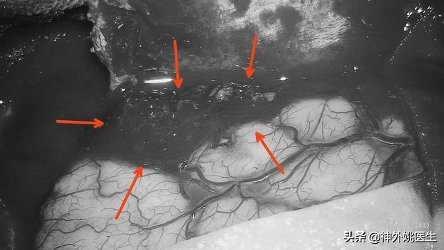 脑膜瘤是什么原因引起的啊,脑膜瘤手术治疗全部大概多少钱