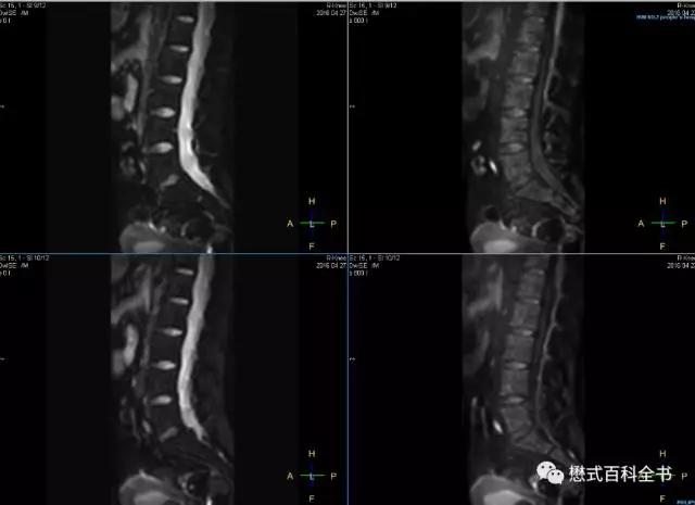 dwi成像序列,dwi序列和edwi序列