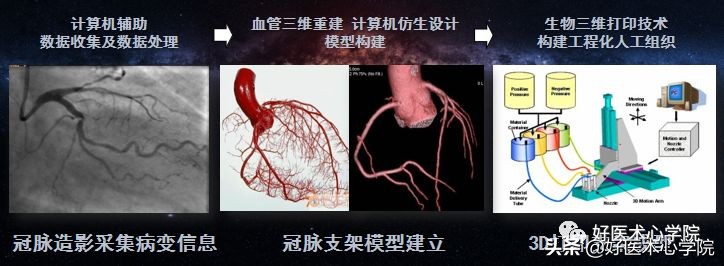 安贞医院冠心病介入治疗新技术,冠心病介入术