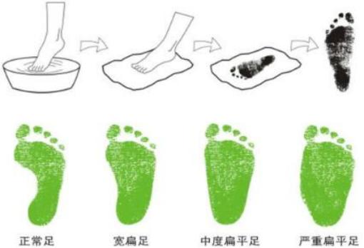 扁平足无足弓自己如何足部训练,足部外翻和扁平足会引起哪些改变