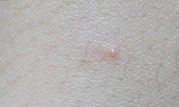 扁平疣不去抓它会继续扩大范围吗,扁平疣抓掉了用什么药好