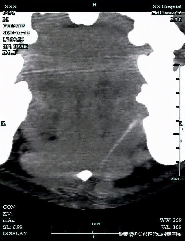 你没看错!下巴脓肿,就是要治牙齿
