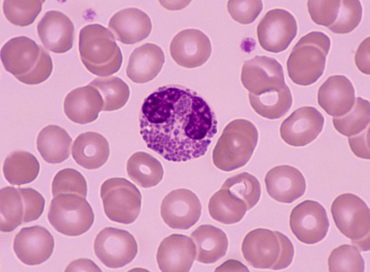 播散性嗜酸性粒细胞增多什么意思,嗜酸性粒细胞增多症血液病