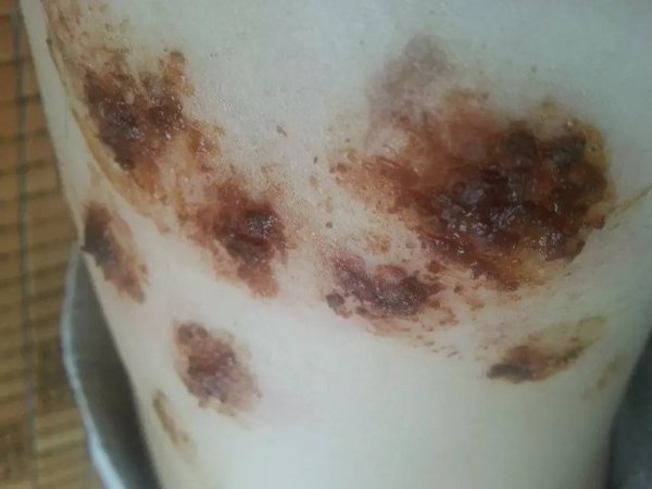 有一种剧痛叫带状疱疹,肋间神经痛与带状疱疹哪个比较痛