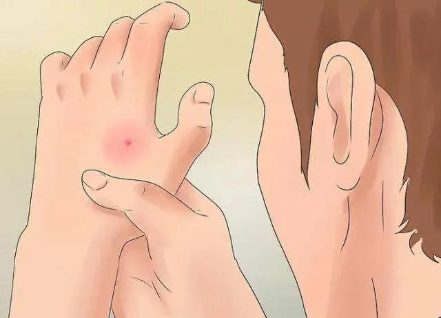 春游被蚊虫咬了怎么办,五一踏青小心毒虫叮咬