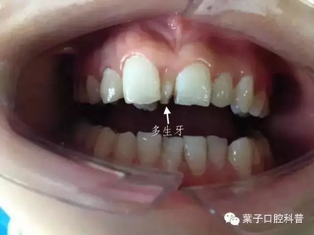 孩子多余的牙齿什么年龄适合拔掉,小孩子的牙齿需要填补吗