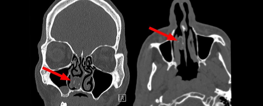 男囚*麻大**深藏鼻孔18年，“烂包裹”变成鼻结石活受罪