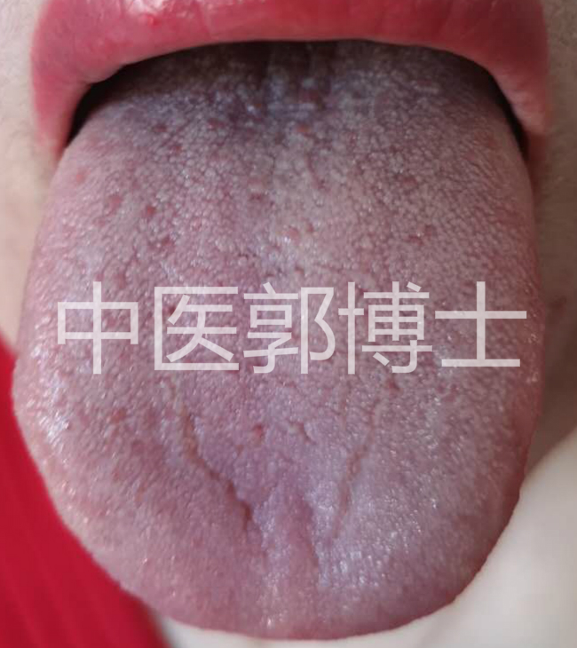 围绝经期崩漏中医治疗,40岁闭经中医辨证