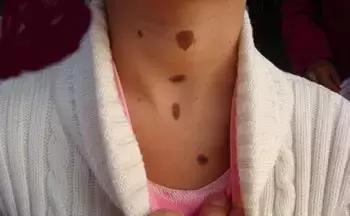 祛斑面诊必背知识点,要祛斑