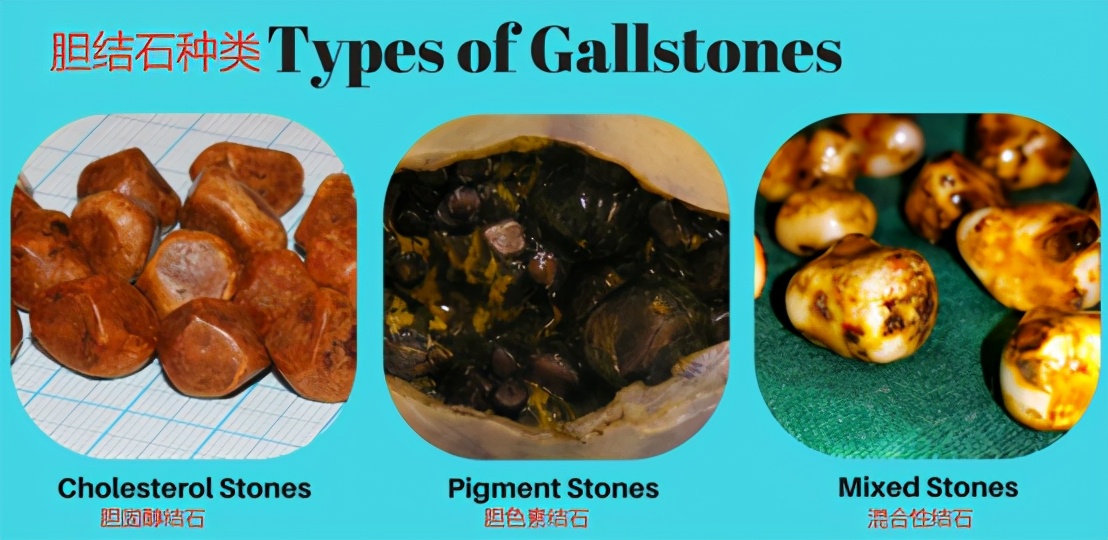 胆结石的形成中医疗法,胆结石的形成及治疗方案