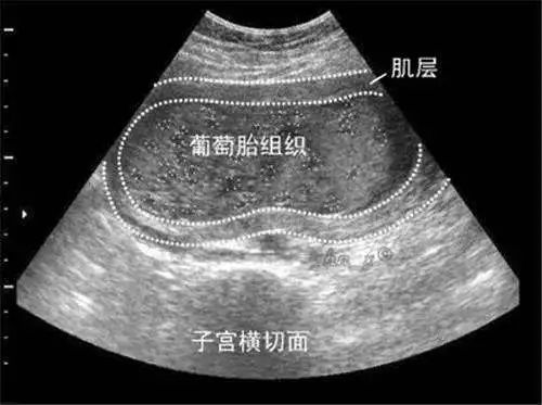 什么情况容易导致葡萄胎,怀孕葡萄胎有哪些特征