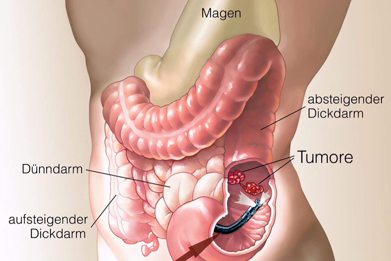 做胃镜发现有息肉建议切除吗,做胃镜发现息肉可以直接切除吗