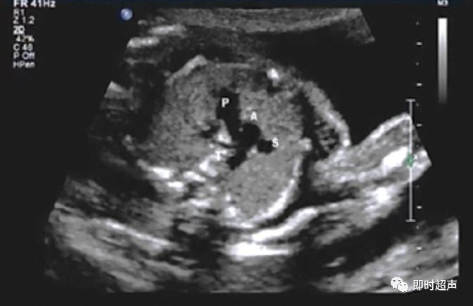 胎儿心脏三种血管关系模式图,25周的胎儿心脏弓切面多少正常