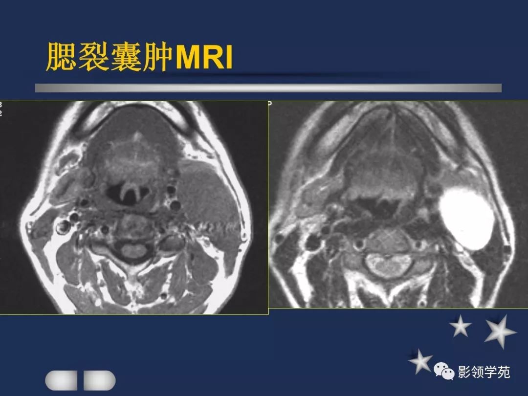 腮腺疾病影像学诊断,腮腺肿块影像诊断