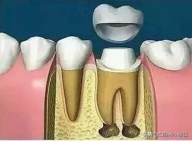 牙齿根尖发炎痛,牙齿持续性剧烈疼痛是牙髓炎吗
