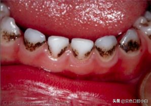 宝宝牙齿黄黄的刷不干净怎么办,宝宝不爱刷牙牙齿黑了怎么办