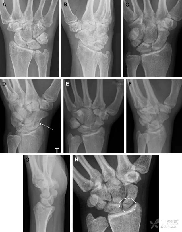 常见的八种骨折,容易漏诊的肩关节骨折