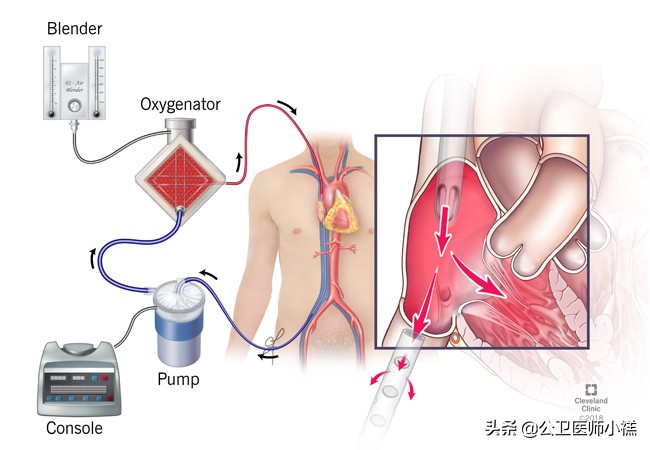 新型冠状病毒肺炎患者的肺,新型冠状病毒患者肺部体征
