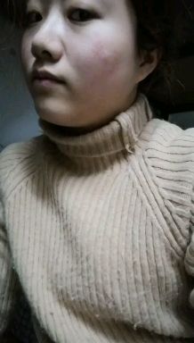 陈金西细胞祛疤真实性,陈金西细胞种植毁容