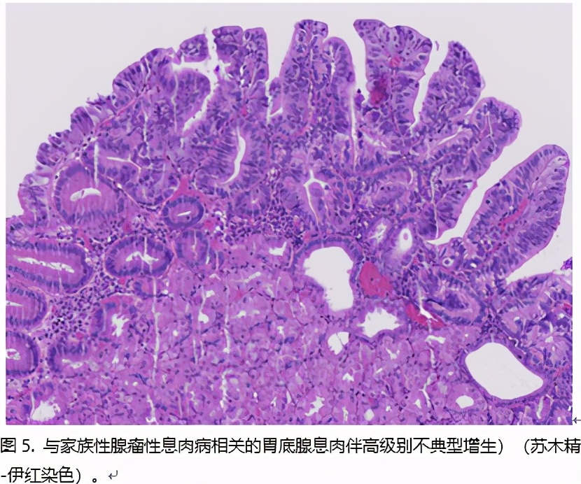 胃息肉可怕不,做胃镜查出胃里有息肉怎么办