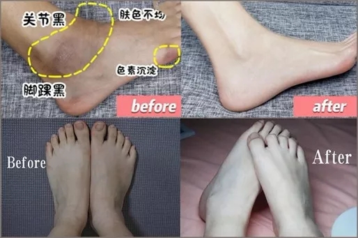 祛背部痘印的日常方法,用什么可以祛后背痘印