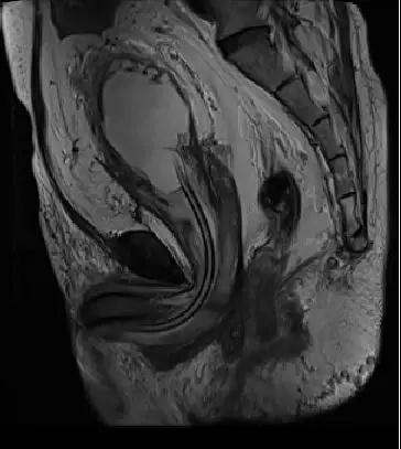 OMG！脂肪长到盆腔里！吓得我赶紧扔掉了手里的鸡腿肉