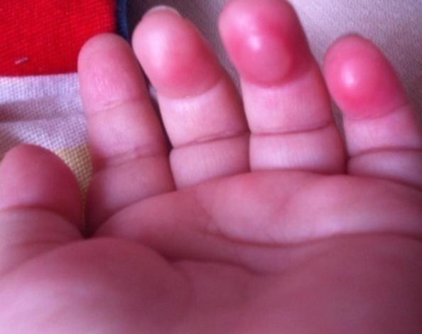 孩子误吞纽扣电池怎么办,孩子误吞了纽扣电池应该吃什么