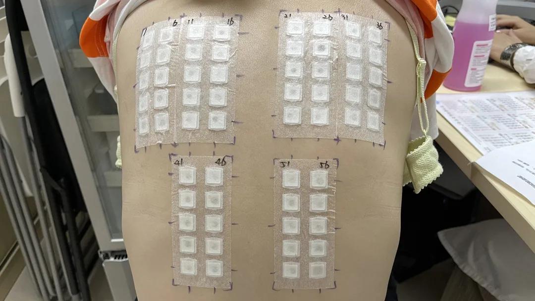 对紫外线过敏是不是过敏性皮炎,对紫外线过敏是缺什么吗