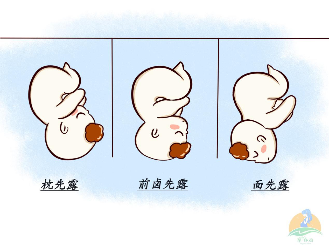 孕妈怎么知道胎位不正,临产胎位不正怎么纠正最快