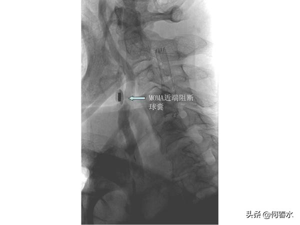 颈动脉狭窄介入治疗,颈动脉狭窄介入手术多少钱
