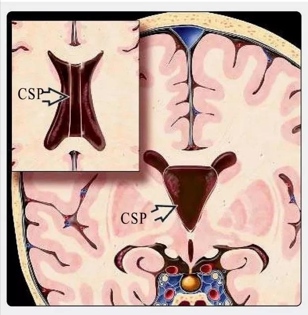脑室透明隔间腔,第五脑室是什么意思