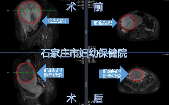 胎盘植入个案护理,凶险性前置胎盘抢救病例分享ppt