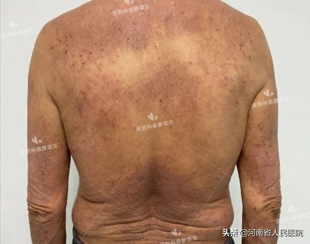 被痒吞噬的人们，是时候揭开这“湿疹”的真面目了