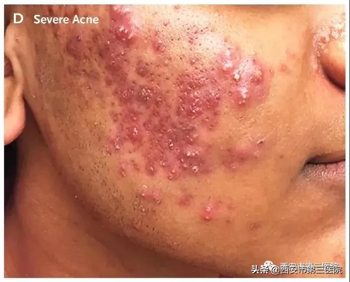 脸上全是痘真正有效的办法,脸上长小痘痘不疼不痒是什么痘