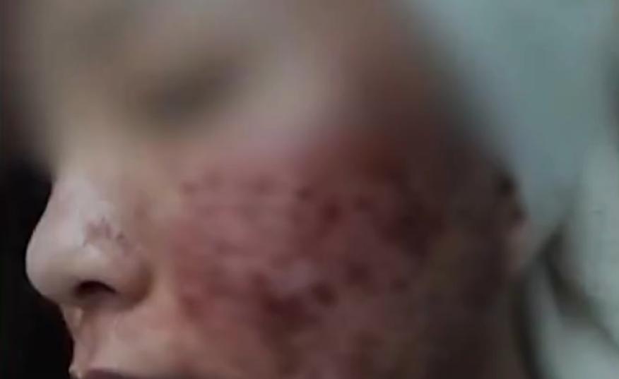 美容会所打瘦脸针险致毁容,注射瘦脸针不当造成感染毁容