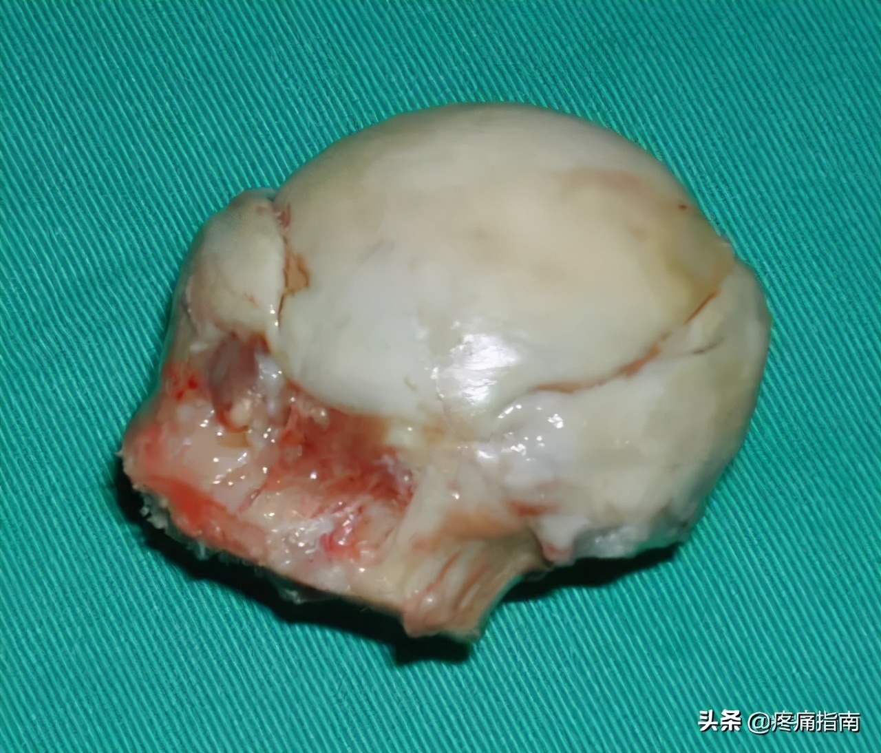 夏天无注射液能治疗骨头坏死吗,骨头坏死用针刀镜有用么