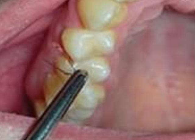 女孩牙龈罕见长出毛发,医生:之前都是男性