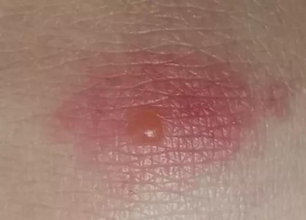 总被蚊子咬有什么驱蚊妙招,为什么老是被蚊子咬怎么解决