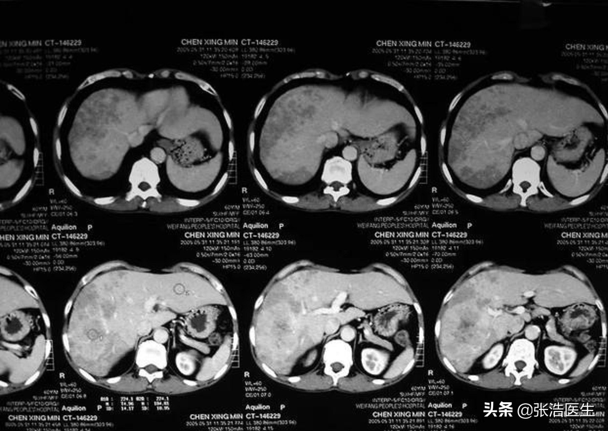 癌症化疗后身上发痒是怎么回事,癌症病人身上发痒是怎么回事