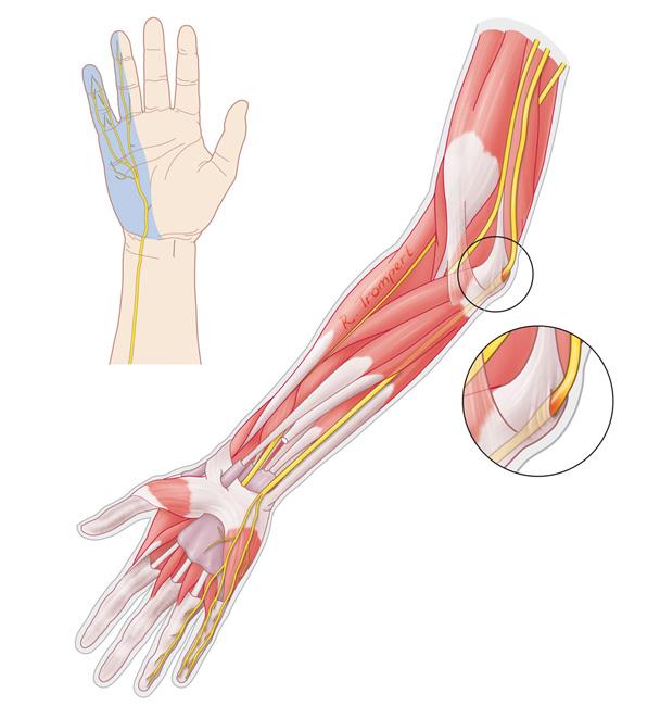 “医生,我胳膊肘伸不直了,还用不了筷子了,我是怎么了啊?”