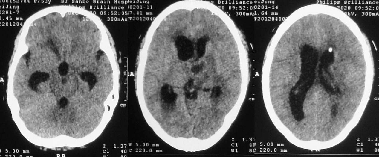 脑脓肿合并脑膜炎需要手术吗,脑脓肿进入左侧脑室严重吗