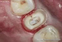 纤维桩修复费用,纤维桩修复全过程视频